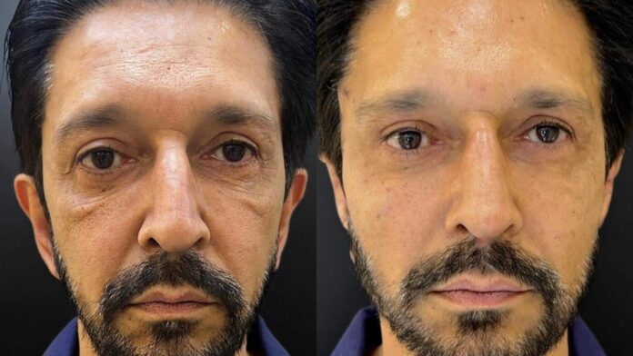 prefeito-de-sao-paulo-aparece-com-novo-visual-apos-harmonizacao-facial prefeito-de-sao-paulo-aparece-com-novo-visual-apos-harmonizacao-facial