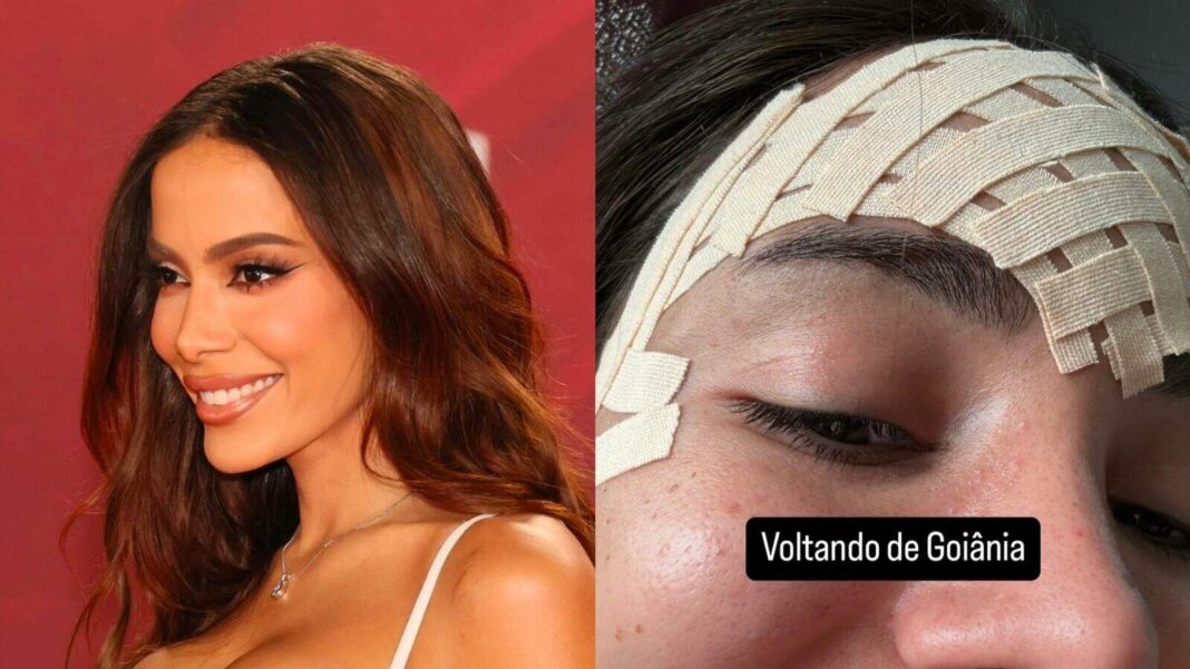 anitta-realiza-cirurgia-para-remover-veia-da-testa