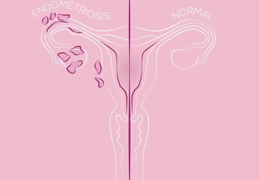 diagnosticar-cedo-salva-vidas:-como-a-endometriose-afeta-7-milhoes-de-mulheres-no-brasil