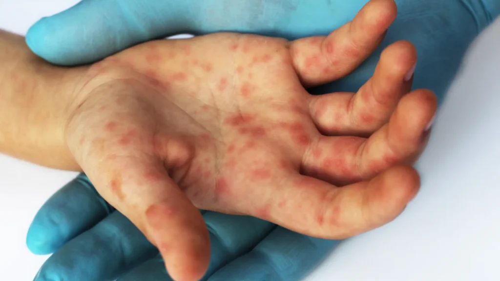 Acre registra 32 notificações de sarampo em 2025