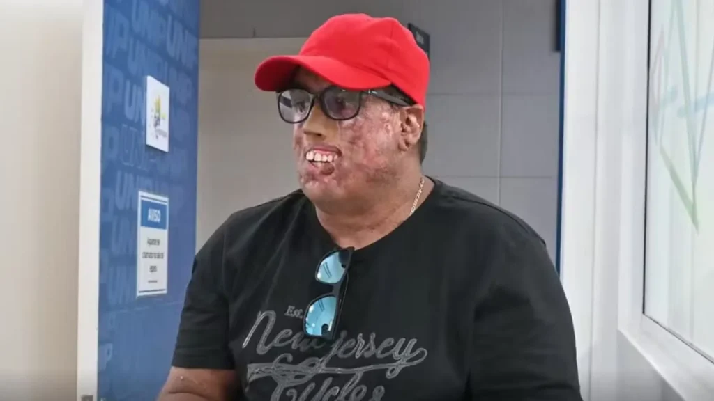 homem-com-doenca-rara-passa-por-230-cirurgias-no-rosto-e-ganha-protese