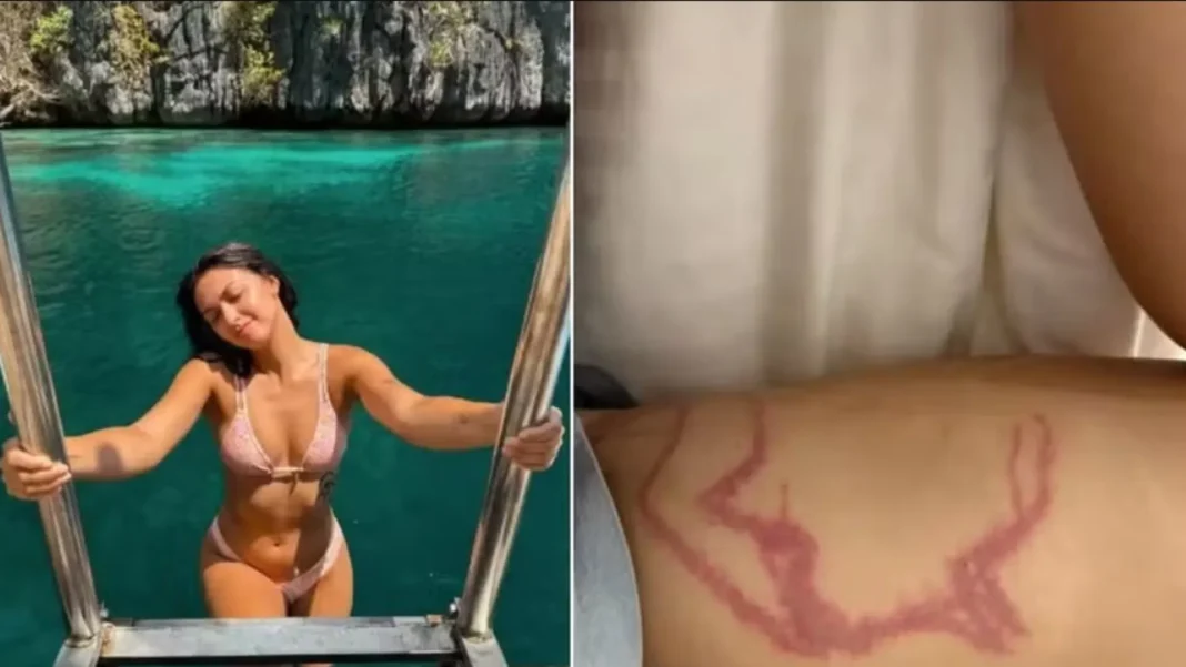 influencer-e-picada-por-especie-de-agua-viva-“mais-venenosa”-do-mundo