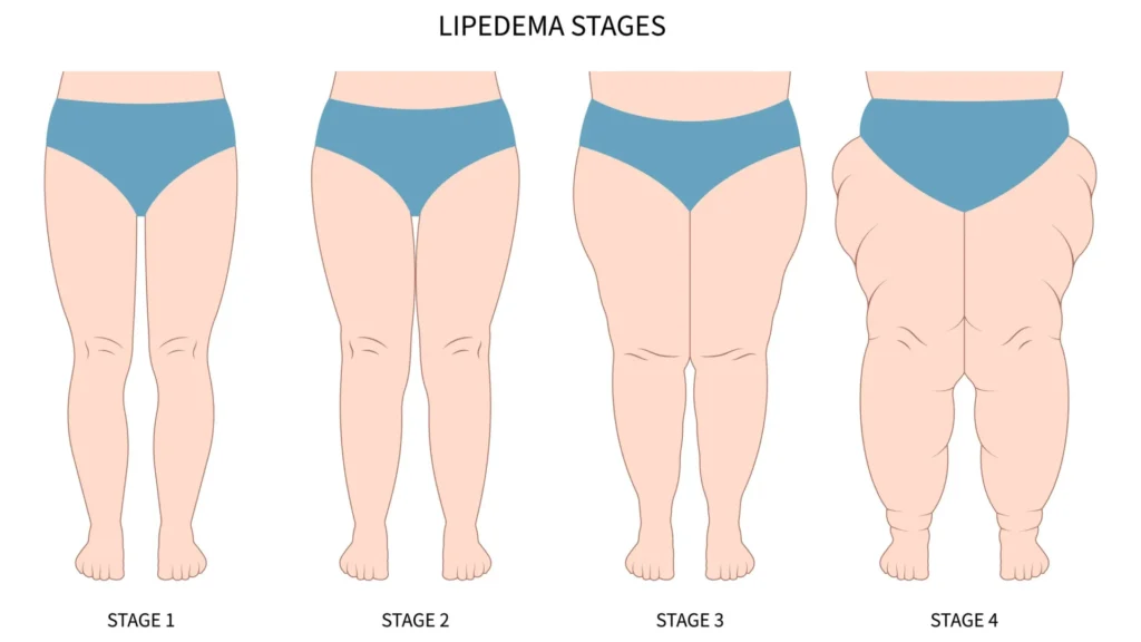 lipedema-e-hereditario?-especialista-responde-as-duvidas-sobre-a-condicao