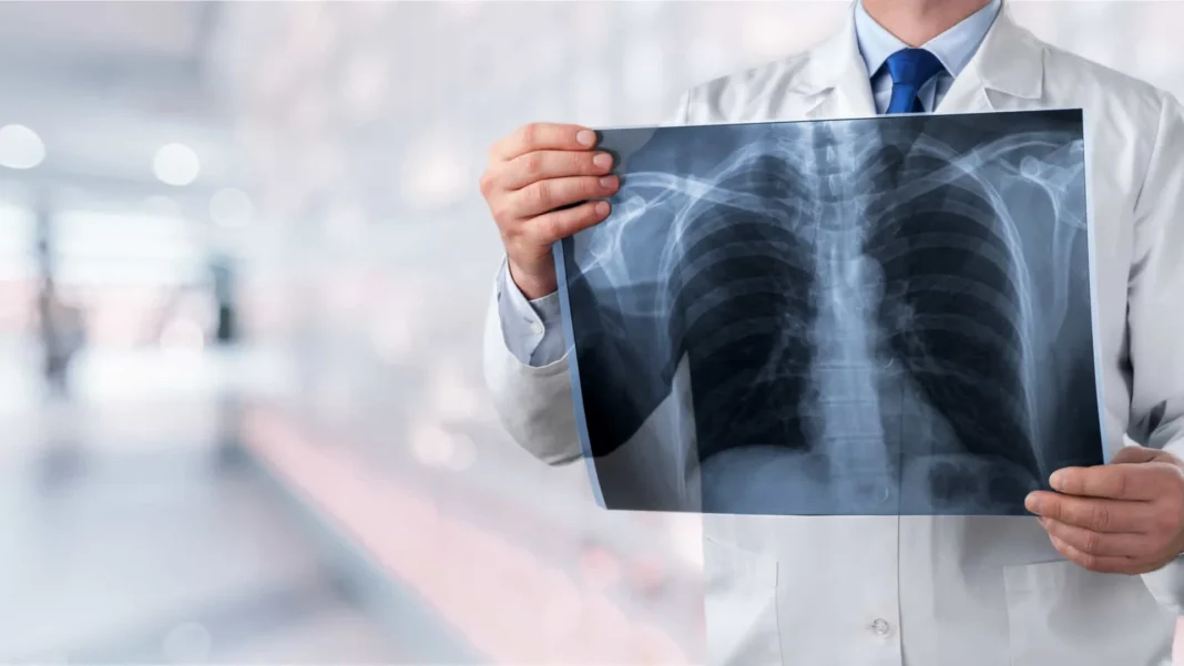 novo-tratamento-reduz-risco-de-morte-em-tipo-de-cancer-de-pulmao-que-atinge-mais-mulheres