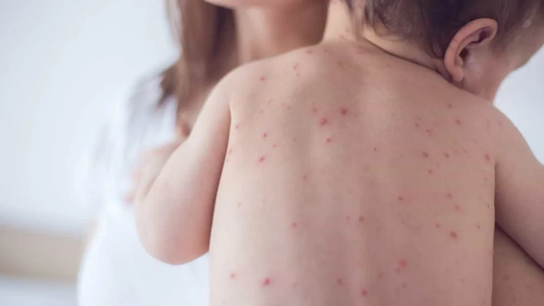rio-tem-registro-de-2-casos-de-sarampo-em-bebes