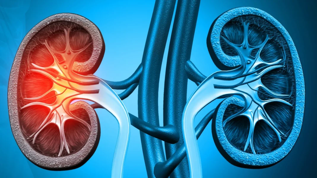 cancer-renal:-tumor-apresenta-sinais-somente-em-estagios-avancados