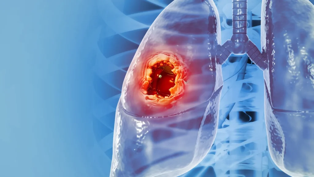 dez-tipos-de-cancer-que-podem-ser-prevenidos