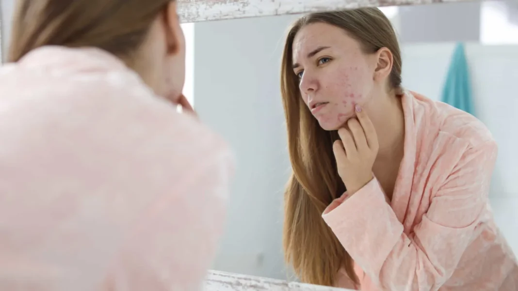 cicatrizes-de-acne,-como-amenizar-e-tratar?