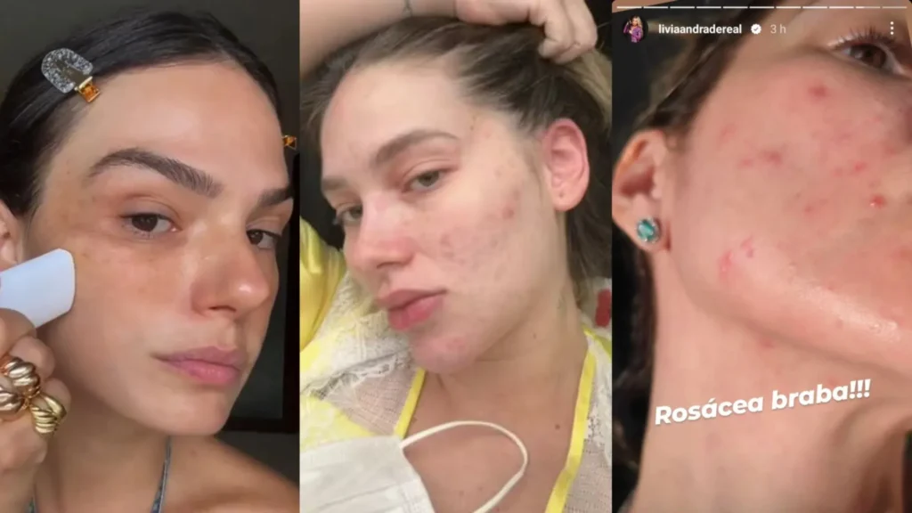 acaro-microscopico-pode-ser-o-causador-da-rosacea-de-famosas