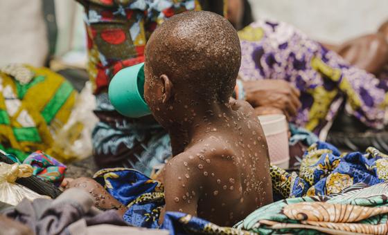 casos-de-mpox-ja-chegaram-a-60-paises