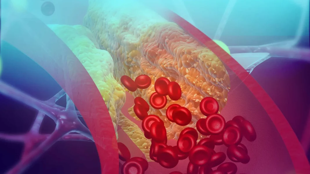 colesterol:-como-prevenir-e-os-erros-que-podem-entupir-suas-arterias