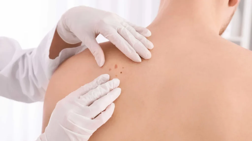 medico-lista-sinais-simples-para-saber-se-uma-pinta-e-cancer-de-pele