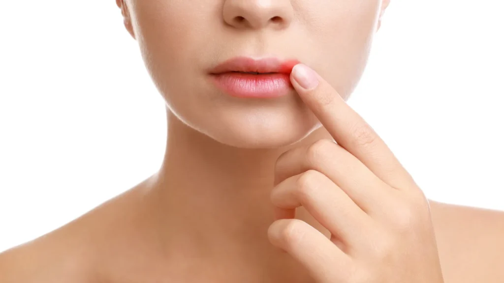 Herpes labial pode aumentar risco de Alzheimer, indica pesquisa – Cidade AC News herpes-labial-pode-aumentar-risco-de-alzheimer,-indica-pesquisa