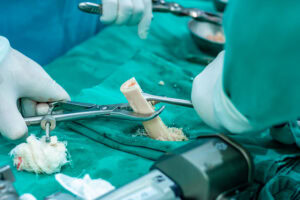 Fundhacre realiza mais um transplante ósseo e reforça importância da doação de órgãos e tecidos | Cidade AC News – Notícias do Acre