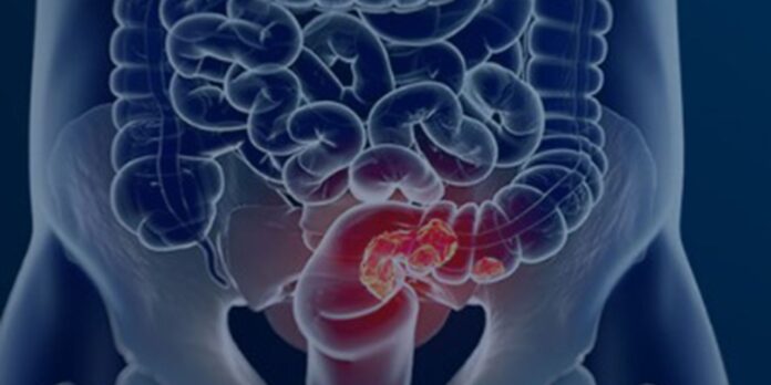 pacientes-com-cancer-colorretal-sao-diagnosticados-em-estagio-avancado