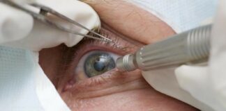 lula-faz-cirurgia-de-catarata;-entenda-a-doenca-e-o-procedimento