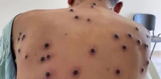 Mpox: Porto Velho registra primeiro caso confirmado de varíola dos macacos mpox:-porto-velho-registra-primeiro-caso-confirmado-de-variola-dos-macacos