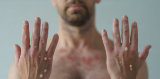 governo-do-acre-confirma-caso-importado-de-mpox-em-brasileia-e-vigilancia-e-reforcada