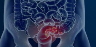 rastreamento-para-cancer-colorretal-pode-ser-implementado-no-sus